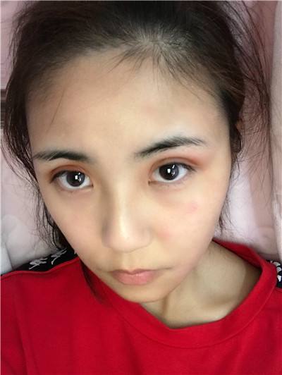 广东画美切开双眼皮怎么样